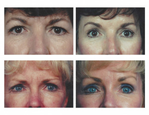 Brow 2