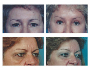 Brow 4