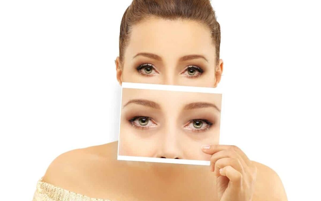 Best Solutions for Dark Circles