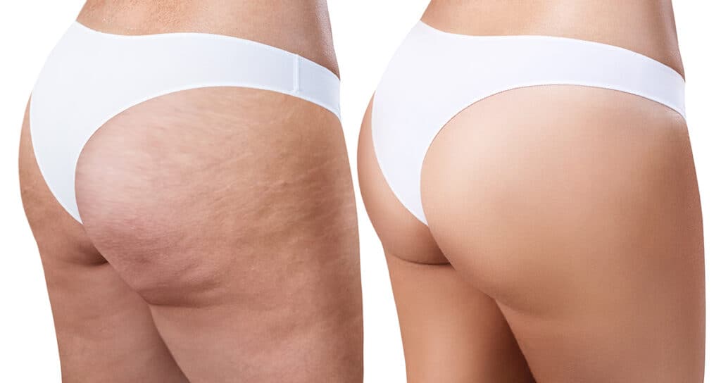 Cellulite removal in Sacramento