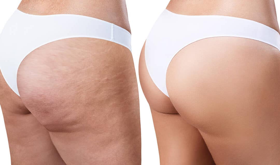 Procedures That Can Reduce Your Cellulite