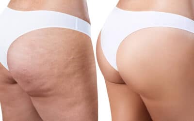 Procedures That Can Reduce Your Cellulite