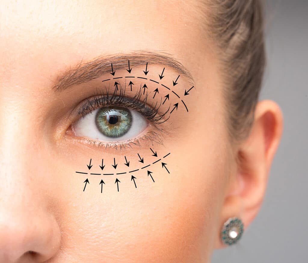 Eyelid surgery Sacramento CA