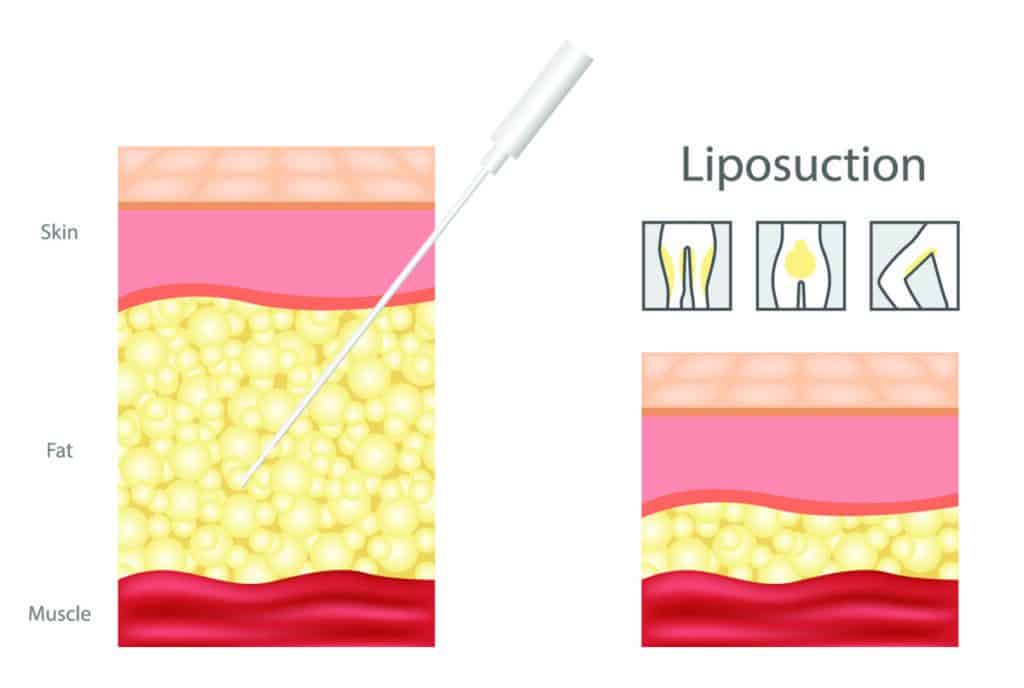 liposuction in Sacramento