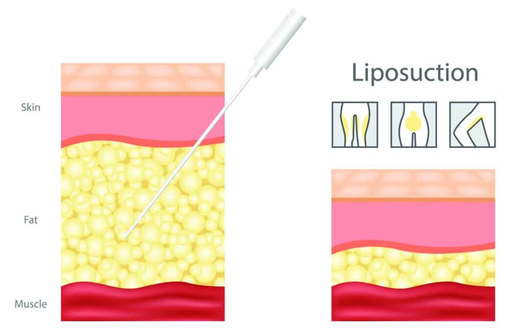 The Science Behind Liposuction – A Top Plastic Surgery