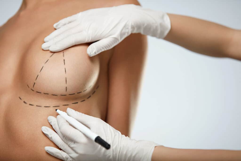When is a Breast Lift Medically Necessary