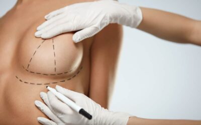 What You Need to Know About Breast Augmentation