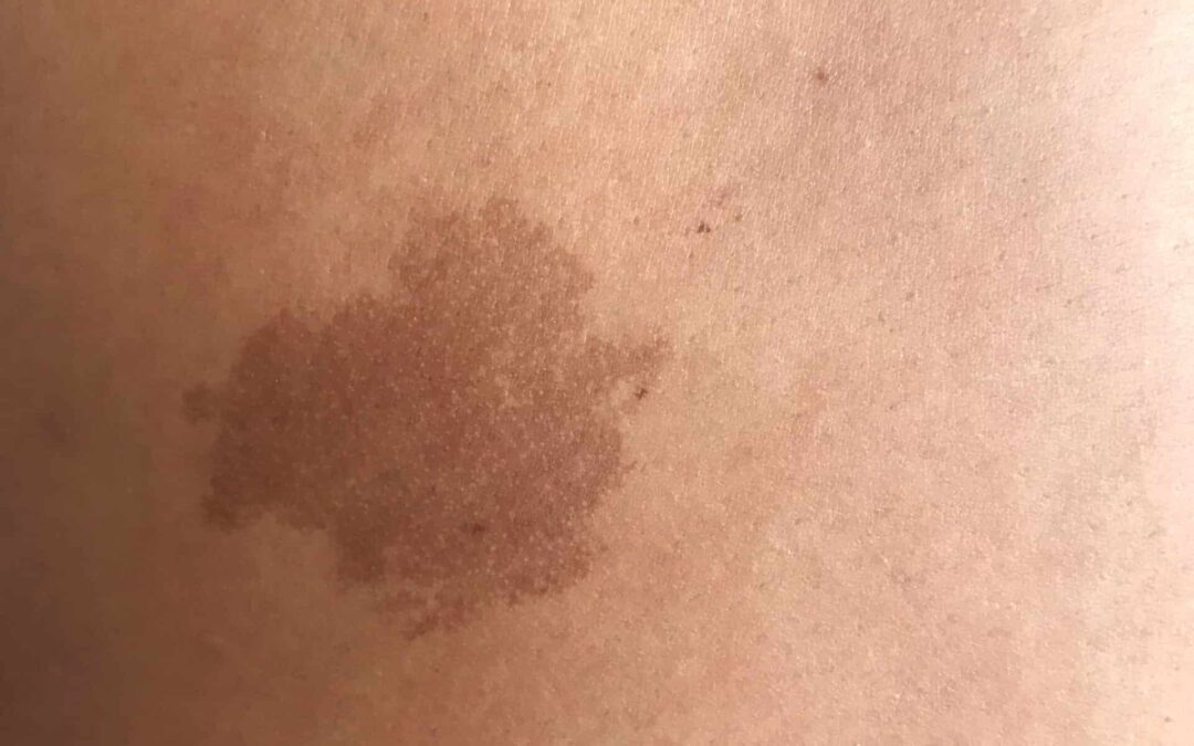 4 Reasons People Choose Medical Tattooing To Cover Skin Abnormalities