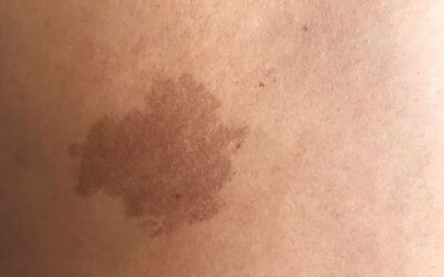 4 Reasons People Choose Medical Tattooing To Cover Skin Abnormalities