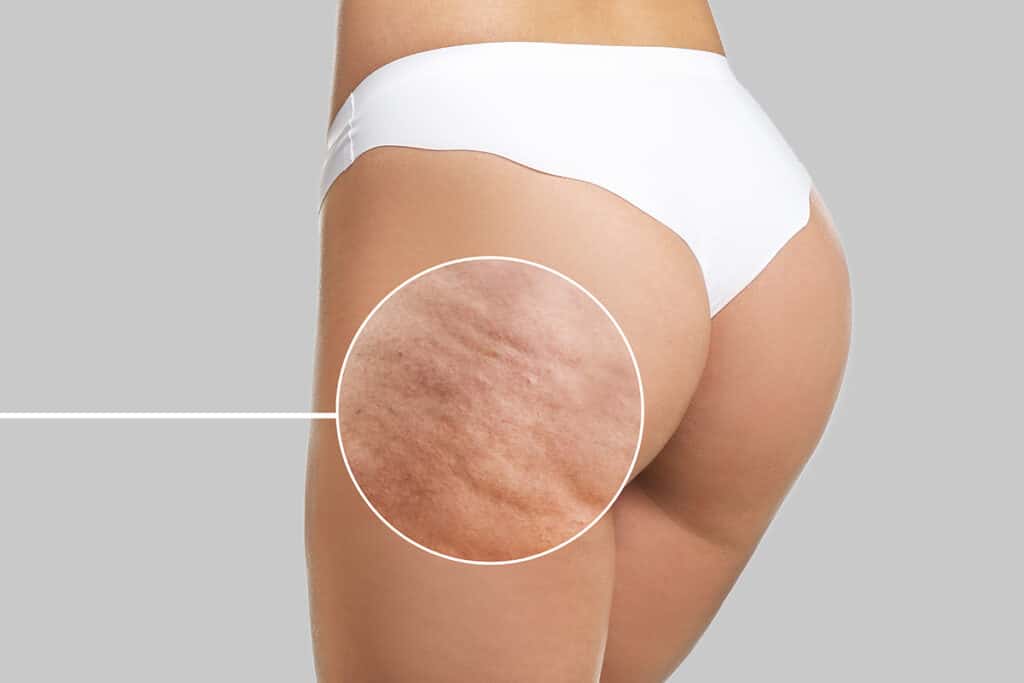 cellulite med spa treatment sacramento