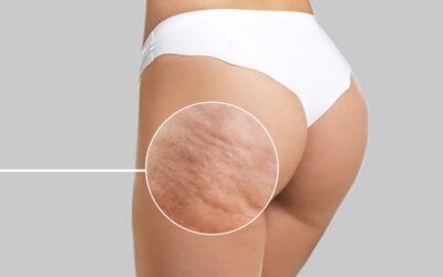 Can Med Spa Treatments Get Rid of Cellulite? Cellfina Offers Smoother Skin