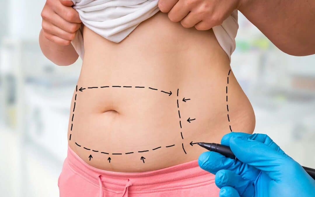 9 Tips for Choosing the Best Mommy Makeover Surgeon for Your Surgery