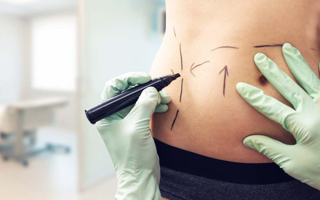 Everything You Need to Know Before Getting a Mini Tummy Tuck