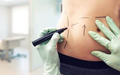 Everything You Need to Know Before Getting a Mini Tummy Tuck