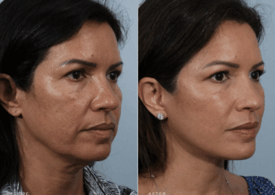 Facelift-B_A-2-1024×756