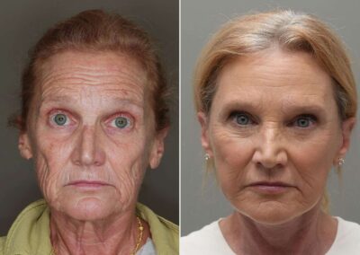 Plastic-surgery-facelift-51825-1-fd9f89cc88694a6d92c14b23bb1267db