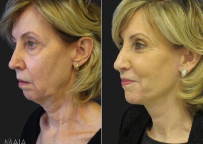 Web-ID-125666-year-old-before-and-after-a-facelift-neck-lift-upper-and-lower-blepharoplasty-brow-lift-facial-fat-grafting-TCA-Peel-and-skincare-treatment