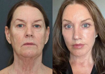 plastic-surgery-5-032625-a87427396c0046a29287c118c2d0b15c