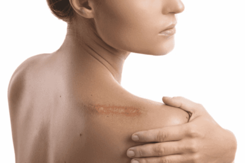 Scar Revision Surgery Sacramento | Improve Scar Appearance