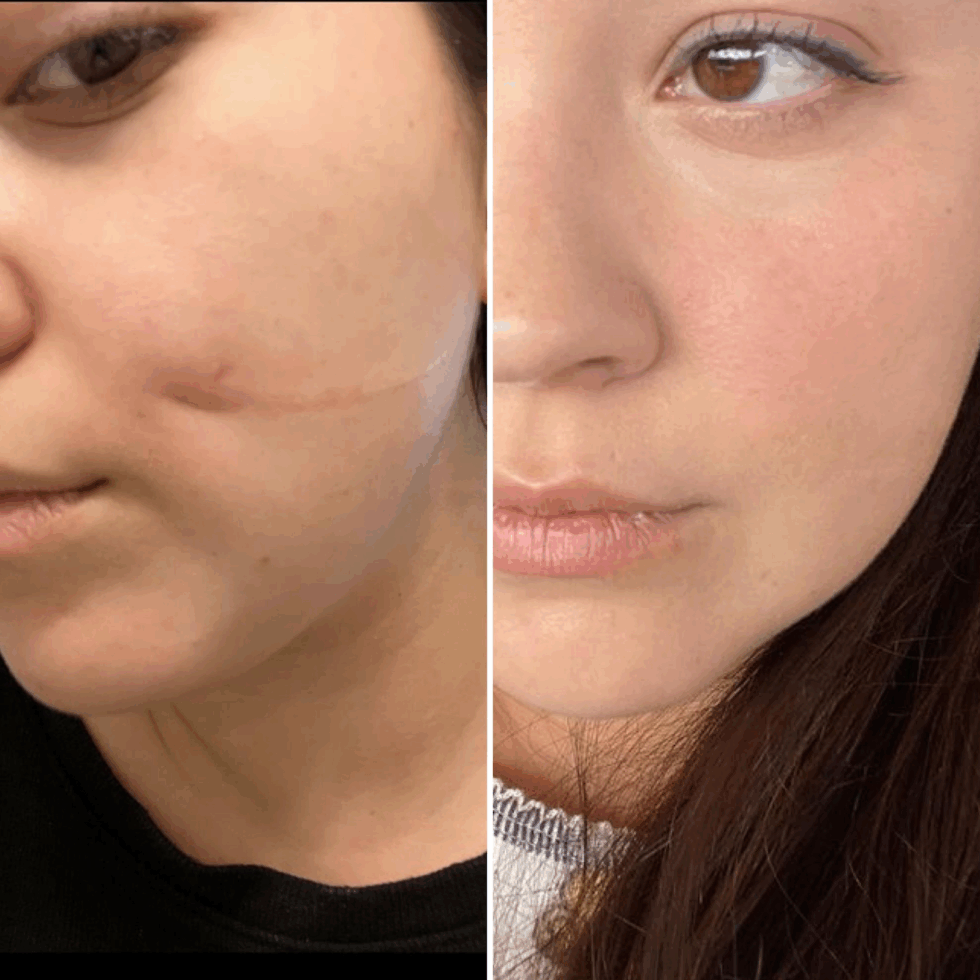 Scar Revision Surgery Sacramento | Improve Scar Appearance